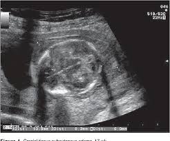 Ulnar dimelia is a congenital deformity where the radial ray, the radius, scaphoid, trapezium, first metacarpal, and the phalanges of the thumb are. Figure 1 From Ballantyne Syndrome Mirror Syndrome Associated With Severe Non Immune Fetal Hydrops A Case Report Semantic Scholar