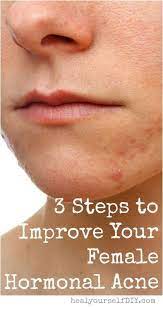 Simple Steps To Follow To Get Rid Of Acne Health And Skin Care Hormonal Acne How To Get Rid Of Acne Acne Treatment