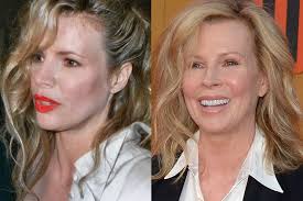 Pin On Face Surgeries