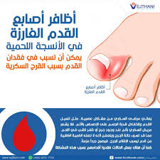 أظافر أصابع القدم الغارزة في الأنسجة اللحمية يمكن أن تسبب في فقدان القدم  بسبب القرح السكرية - Vejthani Hospital