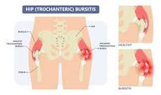 Image result for icd 10 code for trochanteric bursitis bilateral hips