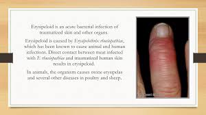 Image result for Erysipeloid