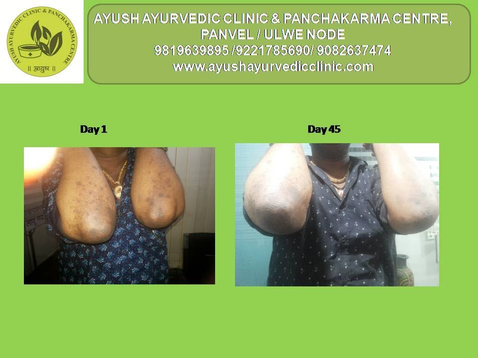 psoriasis treatment 20% off product image