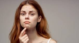 Why Am I Still Getting Acne as an Adult?