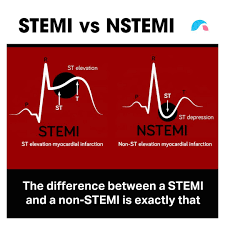 Management (treatment) of nstemi and unstable angina will be discussed in detail. Ausmed Stemi V Nstemi Ausmed Explains Facebook