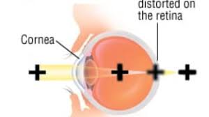 Double vision disappears when closing an eye, and the cause is always an eye misalignment. Patient Basics Double Vision Diplopia 2 Minute Medicine