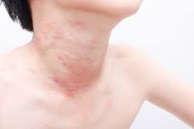 With hives, the histamine causes fluid to release from the blood vessels and makes the skin swell it can be easy to mistake hives for other disorders because the allergy triggers can be difficult to find. Hives Treatment Thomson Specialist Skin Centre