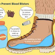 As a result, dark red or purplish blisters formed beneath the skin, visible as blisters. Blood Blisters An Overview