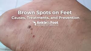 Image result for brown patches on the feet