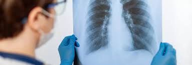 Check spelling or type a new query. What Are The Symptoms Of Pneumonia Reid Health