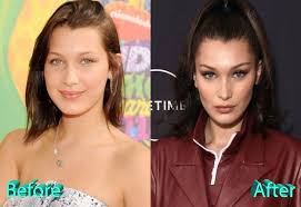 Bella hadid in 2010 (left) and in 2019 (right). Bella Hadid Before And After Plastic Surgery Celebrity Plastic Surgery Plastic Surgery Bella Hadid Surgery