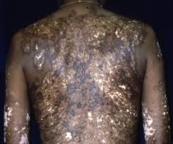 Image result for Diffuse Hyperpigmentation