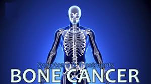 Taking out the cancer or relieving symptoms of the cancer in an operation. Bone Cancer Causes Types Signs Symptoms Treatment