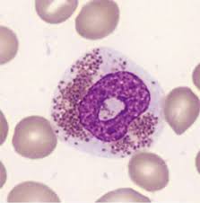 Maybe you would like to learn more about one of these? Klonale Eosinophilie Erkennen Und Einordnen