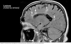 This article is an updated version of the 2013 article and focusses on the role of mri in the diagnosis of multiple sclerosis. Ø§Ù„ØªØµÙ„Ø¨ Ø§Ù„Ù…ØªØ¹Ø¯Ø¯ Ø§Ù„ØªØ´Ø®ÙŠØµ ÙˆØ§Ù„Ø¹Ù„Ø§Ø¬ Mayo Clinic Ù…Ø§ÙŠÙˆ ÙƒÙ„ÙŠÙ†Ùƒ