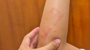 Jika penasaran, simak dulu penjelasan yang sudah glints persiapkan berikut ini, ya! Penyakit Dermatitis Kontak Gejala Penyebab Dan Cara Mengobati Halodoc Com