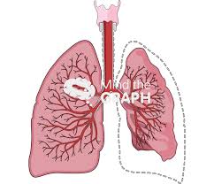 Image result for Atelectasis