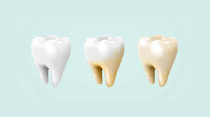 Image result for Tooth Discoloration