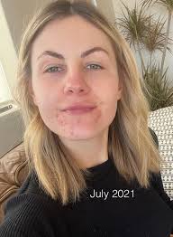 Acne outbreaks after using product, seeking advice