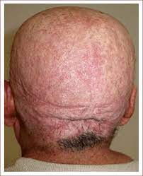 May 6, 2020 at 8:40 am. Nearly Complete Hair Loss At 2 Months After Chemotherapy Anagen Download Scientific Diagram