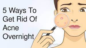 14 Effective Ways To Get Rid Of Acne Fast According To Dermatologists |  Acne Treatment, Back Acne Treatment, How To Get Rid Of Acne