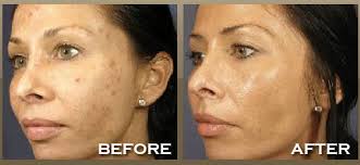 Maybe you would like to learn more about one of these? Chemical Peels Face Effects By Jodi