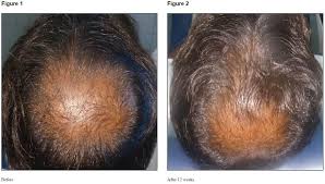 Hair disorders such as hair loss (alopecia) and androgen the in vitro models. The Dermal Papilla Understanding It To Help Reverse Hair Loss