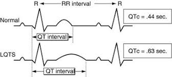 Image result for QT Interval