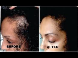 Tight braids, cornrows or ponytails are among the most common culprits responsible for traction alopecia in black women, according to the american academy of dermatology 3 4. How To Stop Hair Breakage And Hair Damage With Black African American Hair Growth Youtube Stop Hair Breakage African American Hair Growth New Hair Growth