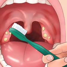 I've been coughing blood, i have really bad stomach aches, my ears are clogged, and my breath smells awful from the puss on my tonsils. 11 Tips For Removing Tonsil Stones That Ll Make You Sigh With Relief