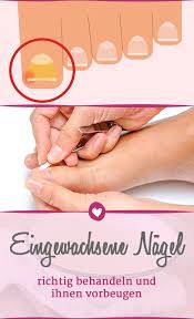 eingewachsener zehennagel tipps zu behandlung und vorbeugung zehennagel zehennagel eingewachsene eingewachsener zehennagel