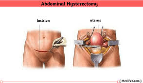 Seeing your photos gives me hope that they will leave very little scarring. Uterus Removal Surgery Hysterectomy Full Procedure Risks And Complications