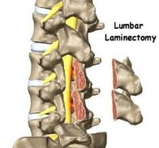 Posterior Lumbar Laminectomy Spine Surgery Lumbar Laminectomy Surgery Hipproblems Spine Surgery Back Surgery Hip Flexor