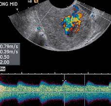 If transabdominal ultrasound is required — because the patient has never been sexually active or declines transvaginal examination — care should be taken that the bladder is adequately filled but not. Physiologic Histologic And Imaging Features Of Retained Products Of Conception Radiographics