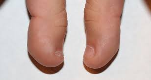 Why Are My Thumbs Uneven Ponder Weasel