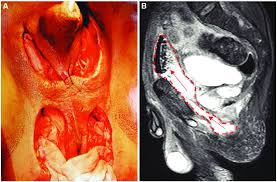 The most fournier families were found in canada in 1911. Fournier Gangrene Without Perineal Involvement A Representative Download Scientific Diagram