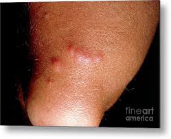 Image result for flea bites