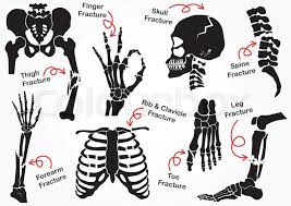 Image Result For Femur Fracture Artistic Bone Fracture Black And White Design Thighs