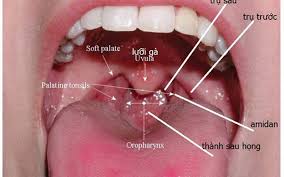 Ung thư vòm họng (bắt đầu từ phần cổ họng ngay sau mũi), hầu họng (phần cổ họng ngay sau miệng, gồm cả amidan), hạ họng hay thanh quản (phần dưới cổ họng, ngay trên thực quản và khí quản), tuyến (khởi phát từ dây thanh âm. Hinh áº£nh Ä'áº§y Ä'á»§ Nháº¥t Vá» Bá»‡nh Ung ThÆ° Vom Há»ng Antican Vn