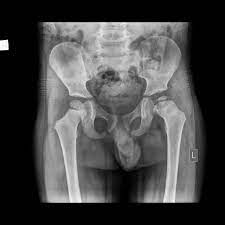 It is characterized by the softening and ultimate breaking. Legg Calve Perthes Disease Radiology Case Radiopaedia Org
