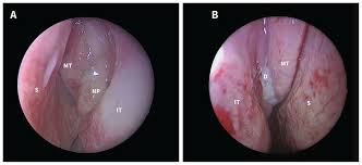 Image result for Sinusitis Prediction Rule