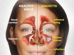 How To Prevent Constant Sinus Infections - Pacific Eye & Ear Specialists