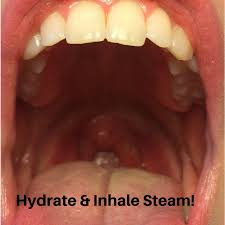How To Rock Your Performance With A Sore Throat Acting Studio Chicago