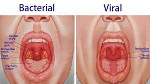 Strep throat is only caused by group a streptococcus bacteria and never by another virus or bacteria. Tonsillitis Tonsillitis Is Inflammation Of The Tonsils It Is A Type Of Pharyngitis Symptoms Include A Chronic Sore Throat Swollen Tonsils Viral Pharyngitis