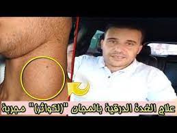 علاج الغدة الدرقية بالمجان لكواثر مجربة مع الباحث في الأعشاب محمد زين الدين youtube health incoming call incoming call screenshot