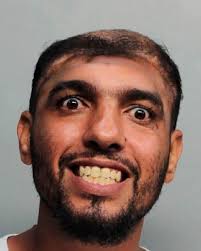 Carlos Rodriguez, a career criminal, lost much of his skull in a car crash  while high