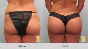 Do i regret my bbl? Brazilian Butt Lift Before And After Photos Riverside Ca