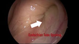 Image result for Eustachian Tube Dysfunction