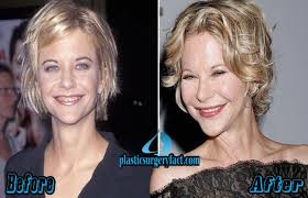 Meg ryan as a young actress. Meg Ryan Plastic Surgery 2016 Meg Ryan New Look At Tony Awards 2016 Celebrity Plastic Surgery Plastic Surgery Facts Plastic Surgery