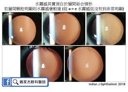 SMILE 全飛秒近視雷射多久可以恢復？